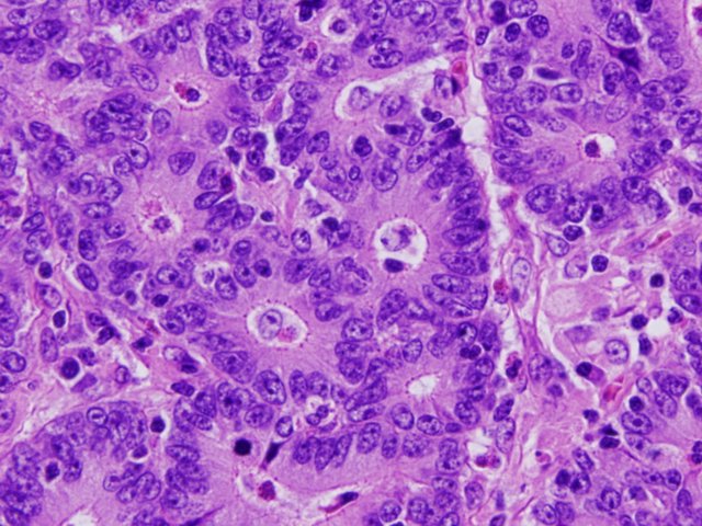 Figura 19. Zonas de adenocarcinoma gstrico con estructuras glanduliformes tubulares.